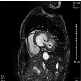 Fig. 2. Preoperative Short-axis cine MR image shows round  out-pouching aneurysm (Asterisk) with over-hanging edge at  both side (Arrows)