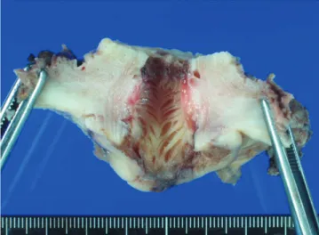 Fig. 3. Catheter which was used for isthmic dilatation.