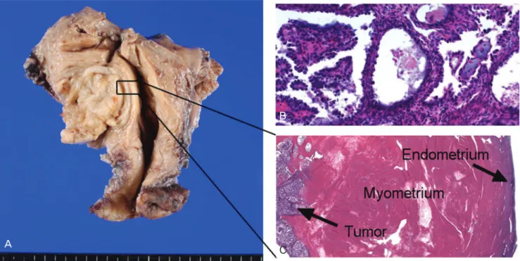 Fig. 2. (A) Yellowish round mass in the myometrium. (B) Microscopic fi ndings of the mass show typical morphologies of clear cell carcinoma (H&amp;E, 
