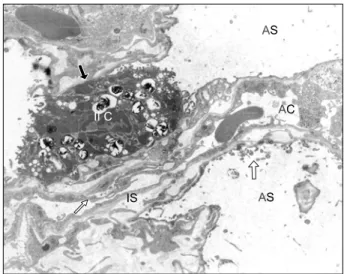 Fig. 10. Nitroglycerin  group. Transmission electron micrograph  shows some alveolar epithelial cell debris (arrow) and luminar  papillary projection of the endothelial cells (small arrow)
