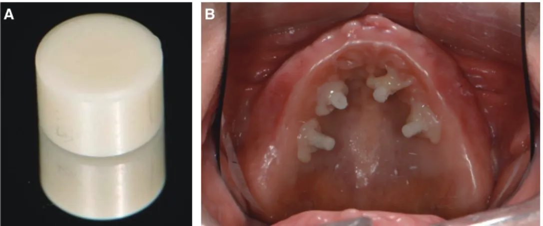 Fig. 2. Digital markers for maxillary scanning and CBCT taking. (A) Digital marker, (B) Bonding 4 markers on palatal area.