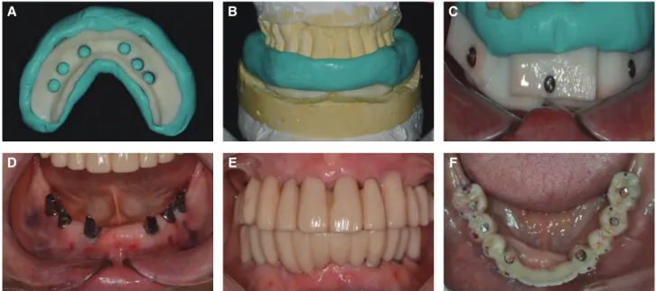 Fig. 8. Implant surgery on mandible. (A, B) Surgical guide fixation index, (C) Surgical guide fixation with three  stabilization screw, (D, E, F) Condition immediately after temporary abutment and prosthesis placement.