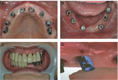 Fig. 9. Digital impression with scan body. (A, B) Intraoral view with scan body, (C) Bite scan using sectional temporary  prosthesis, (D) Merging the scan body.