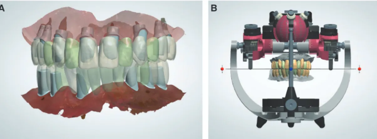 Fig. 10. Designing procedure of definitive prosthesis. (A) Definitive abutment and prosthesis design, (B) Positioning the  definitive prosthesis on virtual articulator for occlusal adjustment.