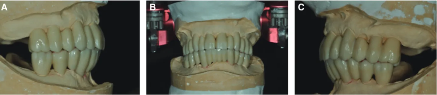 Fig. 12. Definitive prosthesis on stone cast.