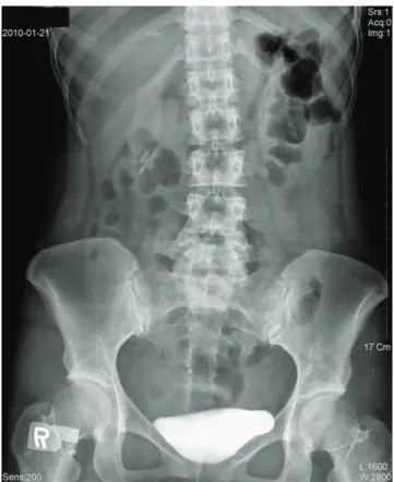 Fig. 2. Plain abdominal X-ray shows mild ileus bowel gas pattern after  computerized tomography scan