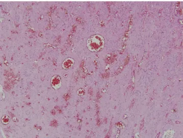 Fig. 4.  Leiomyomatous tissues show multifocal hemorrhage and conges- conges-tion with dilatated vessels, which is typical pathologic features of torsion  (H&amp;E, ×100).