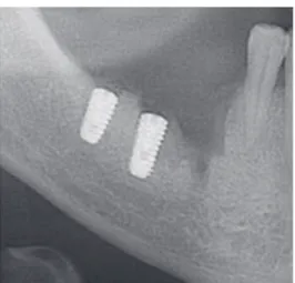 Fig. 1. The related part of the panoramic view of the 1st  case, which shows #47i, 46i and recently extracted #45i  site.