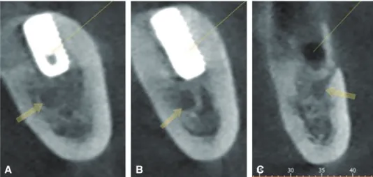 Fig. 2. Dental CBCT coronal views of  #47i (A), #46i (B), #45i extraction site (C). The arrows are pointing the mandibular  canal