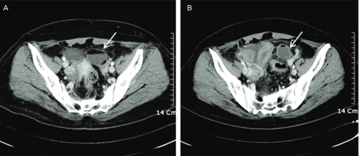 Fig. 2. Intraoperative laparoscopic fi nding shows left ovarian cyst. The  peritoneum, uterus, and bowel surfaces are covered by diffuse, thick,  white to yellowish plaque-like lesion.