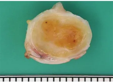 Fig. 1. Gross feature of specimen. Figure shows a 2.0 × 1.7 × 1.5 cm sized  mass. Cut surface is well demarcated, encapsulated and yellowish myxoid.