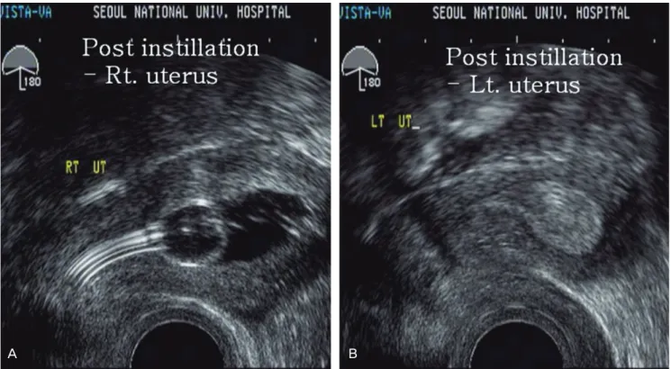 Fig. 5. Laparoscopic fi nding. There were normal ovaries and tubes arising  from each side of uterine cornus