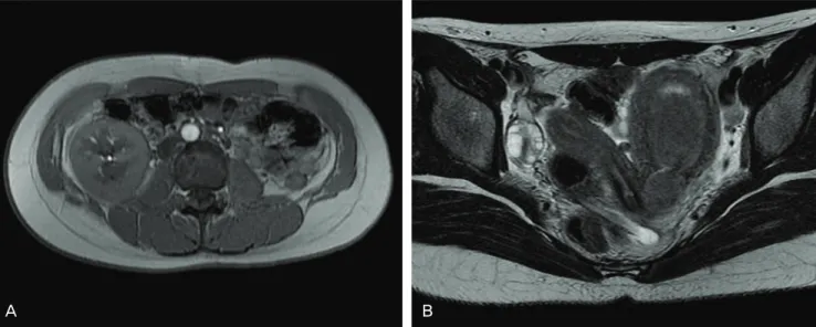 Fig. 2. Pelviscopic fi nding of left hydrosalpinx that adhered to sigmoid  colon.