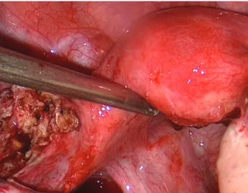 Fig. 5. Pelviscopic fi nding after operation.