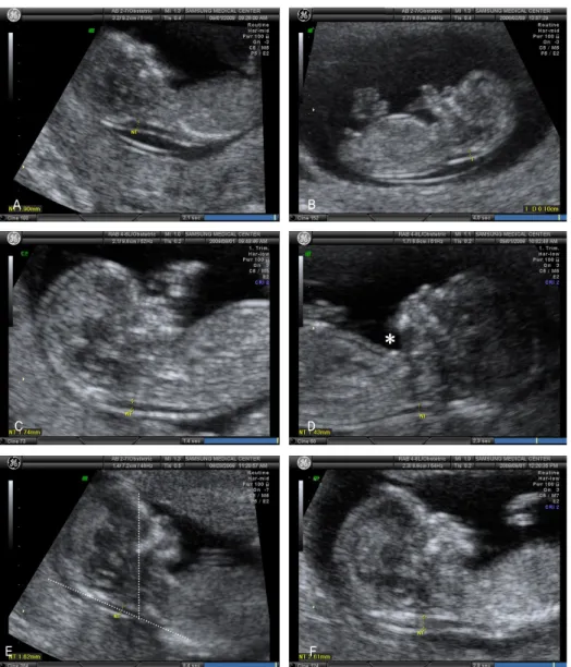 Fig. 2. Examples of nuchal translucency (NT) measurements. (A) Improper midsagittal plane and inadequate magnification