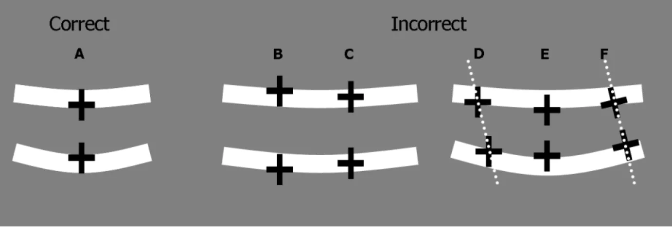 Fig. 3. (A) Proper placement of the calipers for nuchal translucency (NT) measurement