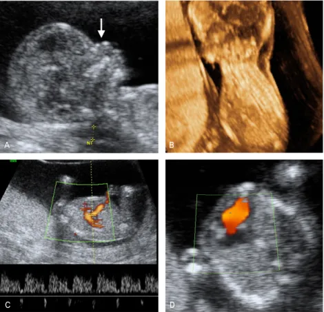 Fig. 5. Abnormally increased nuchal trans- trans-lucency (NT) in a fetus at 13 weeks of  gestation