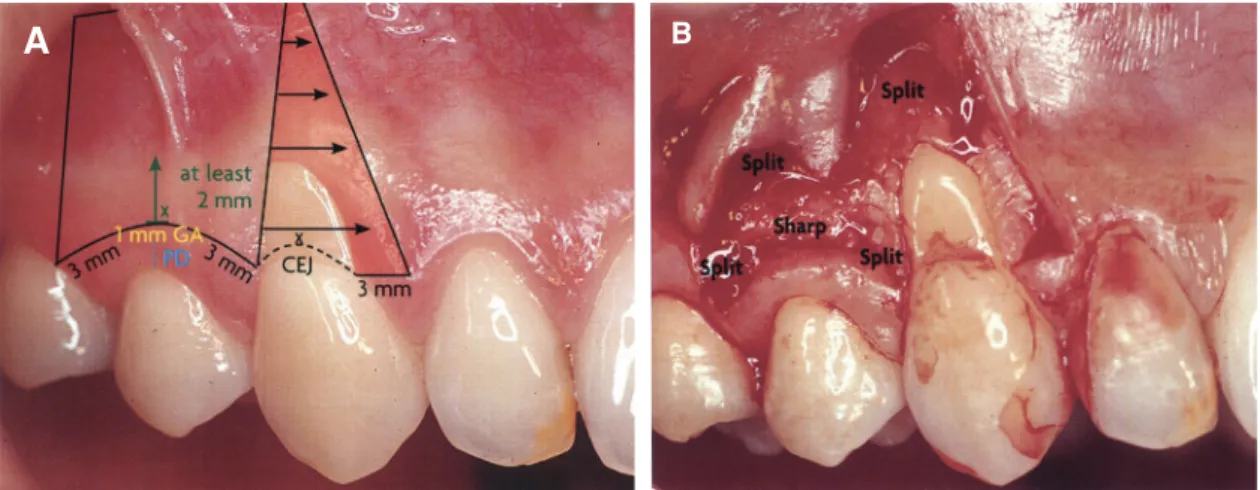 Fig. 1. (A) Donor &amp; recipient site design, (B) Mix-thickness flap. CEJ, cementoenamel junction; Split, split-thickness flap; 