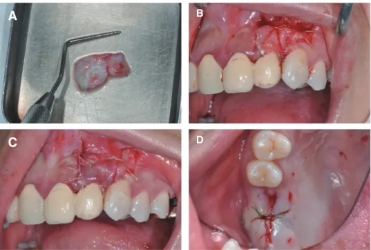 Fig. 9. Clinical view of surgical procedure. (A) Subepithelial connective tissue grafting from edentulous ridge, (B) The  graft tissue positioned at recipient site, (C) A lateral flap was positioned over the connective tissue graft and sutured, (D)  Edentu