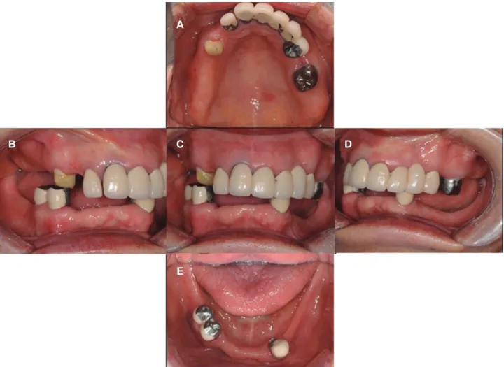 Fig. 2. Intra-oral status in the initial examination. (A) Maxillary occlusal view, (B) Right lateral view, (C) Frontal view at  maximum inter-cuspal position, (D) Left lateral view, (E) Mandibular occlusal view.