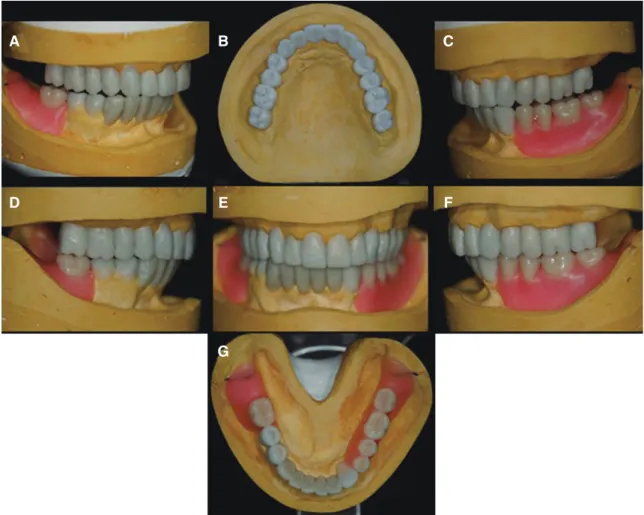 Fig. 3. Diagnostic wax-up model. (A) Lateral movement- right side: group function, (B) Maxillary occlusal view,  (C) Lateral movement- left side: canine guidance, (D) Right lateral view, (E) Frontal view, (F) Left lateral view, (G)  Mandibular occlusal vie