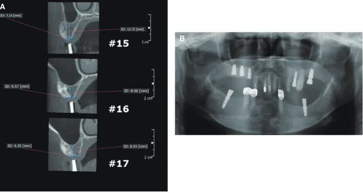 Fig. 5. Panoramic X-ray finding and CT images after surgery. (A) Computed tomography (CT) images after ridge  augmentation on #15, 16 and 17 area