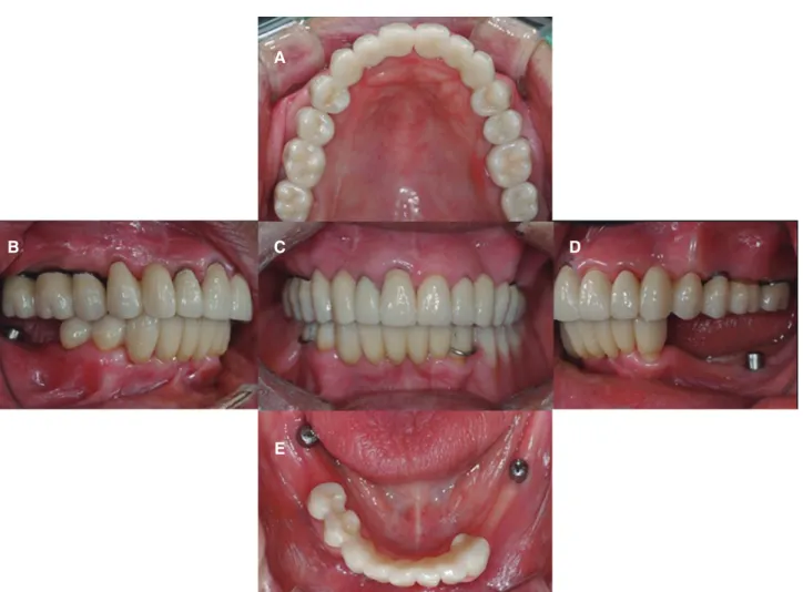 Fig. 7. Definitive fixed prosthesis was delivered. (A) Maxillary occlusal view, (B) Right lateral view, (C) Frontal view at  maximum inter-cuspal position, (D) Left lateral view, (E) Mandibular occlusal view.