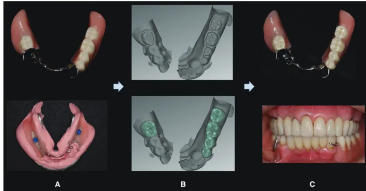 Fig. 10. Post-treatment panoramic radiograph.  산에 더 나은 결과를 보인다고 하였다. 이와는 달리 Kim  등 12 은 제1대구치 부위에 임플란트를 식립하는 것은 임 플란트에 심한 응력이 집중되고 후방 무치악 부위에도  응력이  많이 작용하므로 임플란트 식립 위치는 제2대구 치 부위 혹은 그 후방이 더 적절하다고 하였다