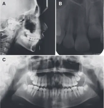 Fig. 3. Intraoral appliance for #21 distraction  osteogenesis after single tooth osteotomy