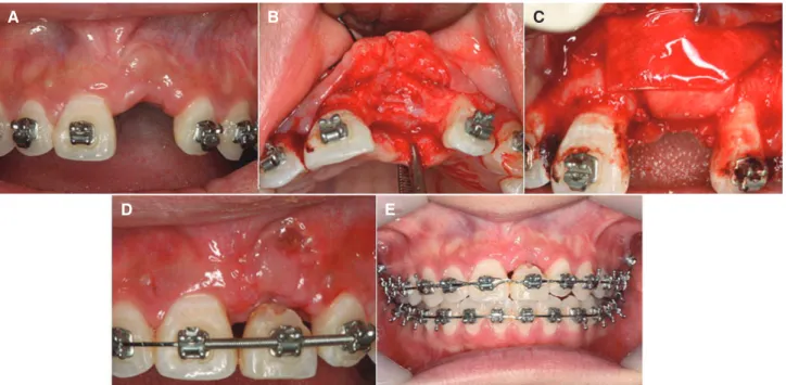 Fig. 8. Extraction of the root rest and GBR procedure. (A, B) Remaining buccal alveolar bone thickness was too thin