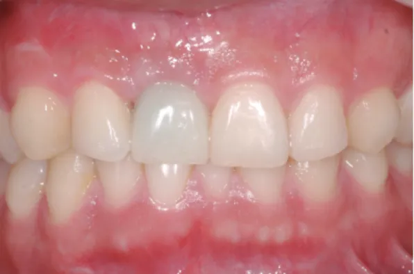 Fig. 2. Soft tissue around implant was well maintained  for 3 months after connecting provision restoration.