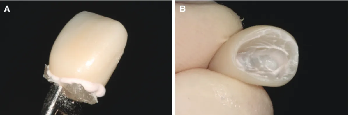 Fig. 4. (A) Apply cement, seat abutment replica, and wipe off excess cement, (B) Remove replica from seating and  confirm that the cement has coated the inside.
