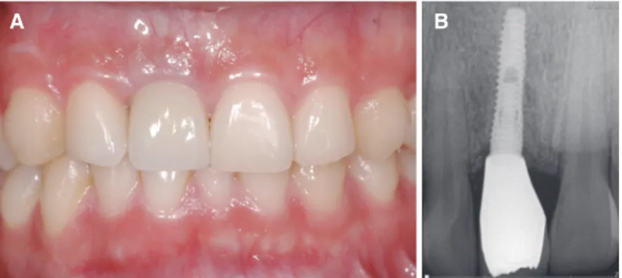 Fig. 5. (A) Zirconia crown was cemented with resin cement, (B) Periapcal radiograph. No cement remaining was  observed.