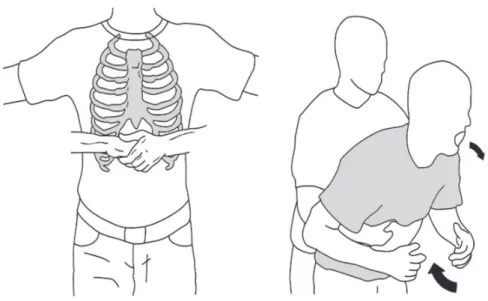 Fig. 4. Abdominal-thrust maneuver.