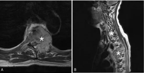 Fig. 1. Magnetic resonance imaging  shows a cord compression at T4  spi-nal level on axial (A) and multiple  levels (C7, T4) on sagittal view (B).