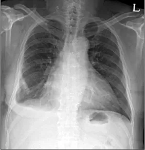 Fig. 2. Postoperative chest radiography (8 th  postoperative day). 
