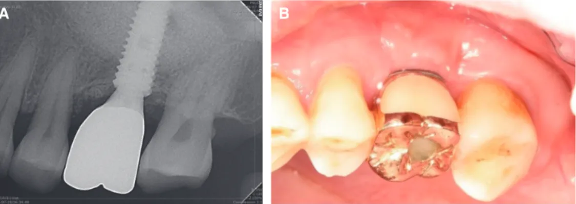 Fig. 2. Radiographic and clinical findings one year after #26i final prosthesis delivery