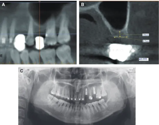 Fig. 5. Radiographic and clinical findings one year after #25i final prosthesis delivery