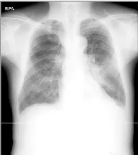 Fig. 3. Broncoscopic findings.  A large pedunculated mass  was occluded in the orifice of right upper lobe bronchus.