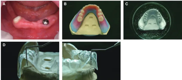 Fig. 6. Space measurement for attachment and denture base. (A) Intraoral photo, (B) Fabricated wax denture, (C)  Duplicate model with wax denture and use thermoplastic resin for taking outer form of wax denture, (D, E) Measure  the available space for atta