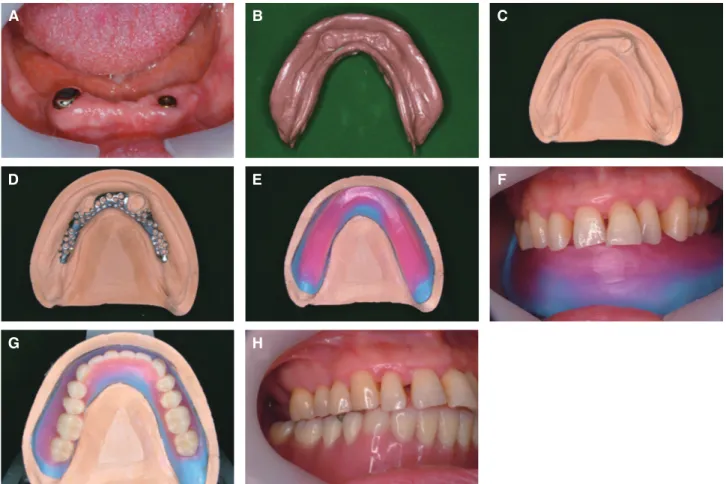 Fig. 10. Fabricating conventional complete denture. (A) Cementing a casted attachment and connecting another  attachement on the implant, (B) Functional impression taking, (C) Master cast, (D) Casted framework, (E) Record base  and wax rim, (F) Vertical di