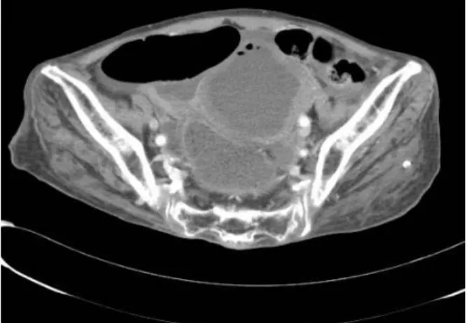 Fig. 2. Notice a 1 cm sized hole on the anterior wall of the  uterus.