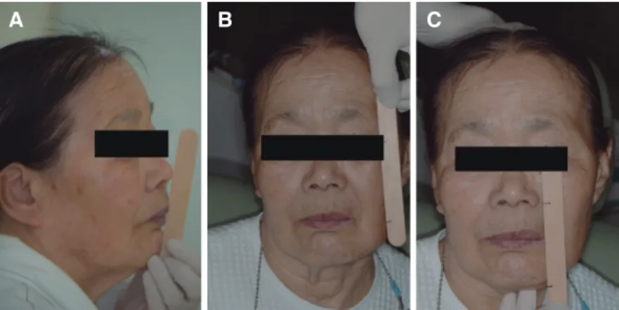 Fig. 4. Determination of vertical dimension. (A) Physiologic resting position, (B) Measurement of distance between the  pupil and mouth corner using Willis method, (C) Measurement of length of lower 1/3 of the face using Willis method.