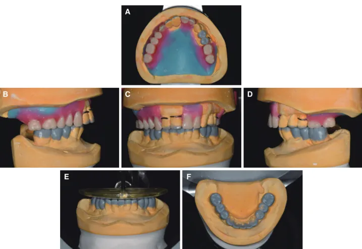 Fig. 5. Diagnostic wax up using new vertical dimension for interim prostheses. (A) Maxillary occlusal view, (B) Right  lateral view, (C) Frontal view, (D) Left lateral view, (E) Harmonious occlusal plane establishment using occlusal plane  guide, (F) Mandi