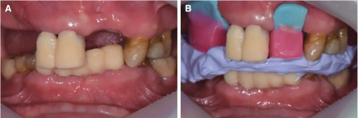 Fig. 7. (A) Mounted models after temporization, (B) Fabrication of customized anterior guide table.