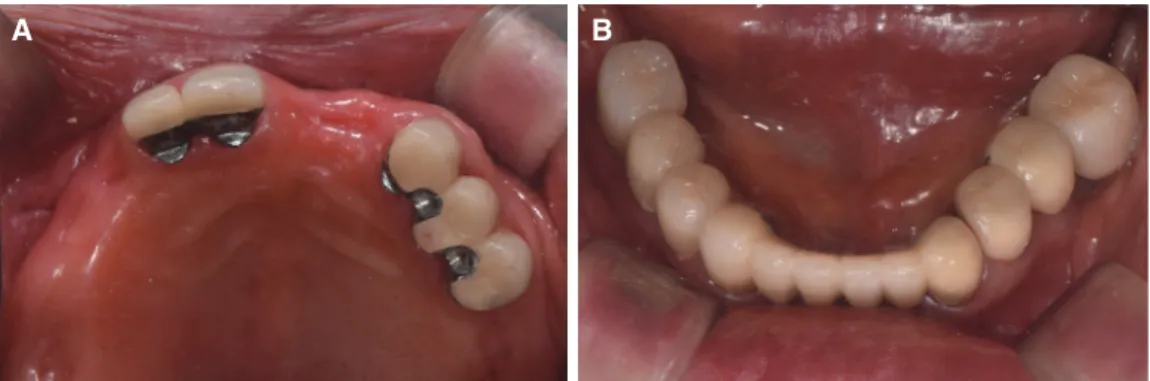 Fig. 9. Deivery of definitive FPDs with increased vertical dimension. (A) Maxillary occlusal view, (B) Mandibular occlusal view.