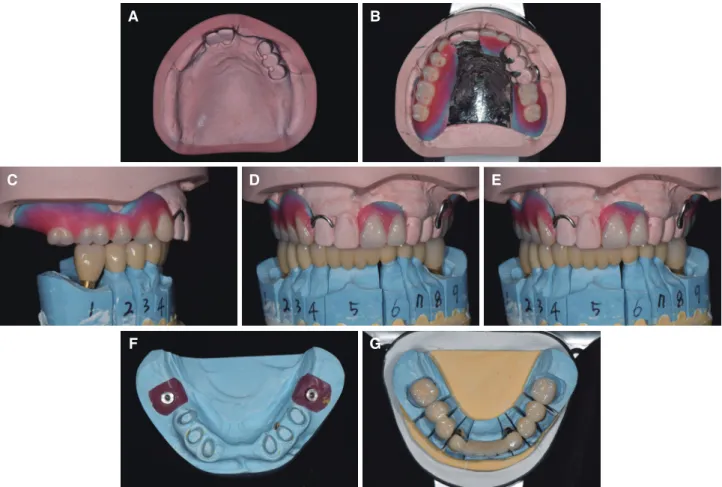 Fig. 10. Definitive prostheses. (A) Maxillary master cast, (B) Maxillary occlusal view of removable partial denture, (C)  Right lateral view, (D) Frontal view, (E) Right lateral view, (F) Mandibular working cast, (G) Mandibular occlusal view of  metal cera