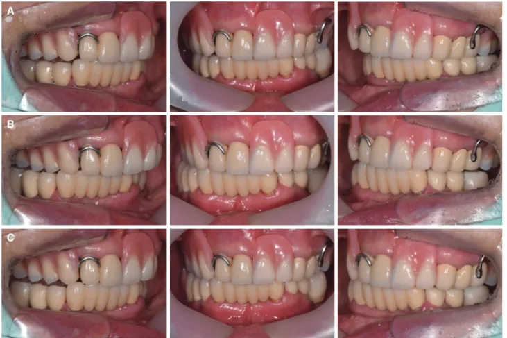 Fig. 11. Establishment of occlusal scheme. (A) Left lateral movement, (B) Right lateral movement, (C) Protrusion.