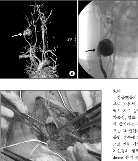 Fig. 1. Large aneurysm at right  carotid bulb area with displaced  and compressed right CCA and  bifurcation (arrow)