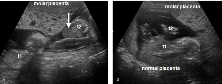 Fig. 1. Transabdominal ultrasonographic findings at 14 weeks 3 days of gestation. (A) A uterus contains diffuse multiple hypoechoic  cysts